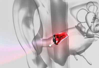 助听器怎么选择？